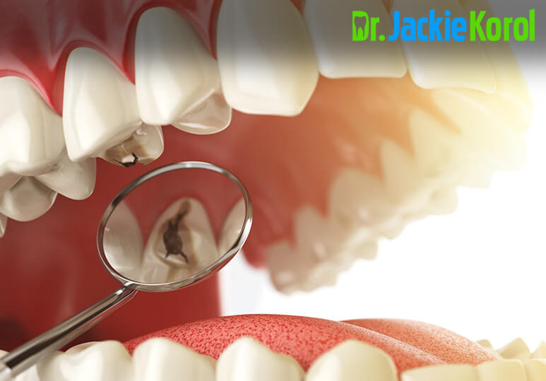 What To ﻿Do When Your Tooth Filling Falls Out?